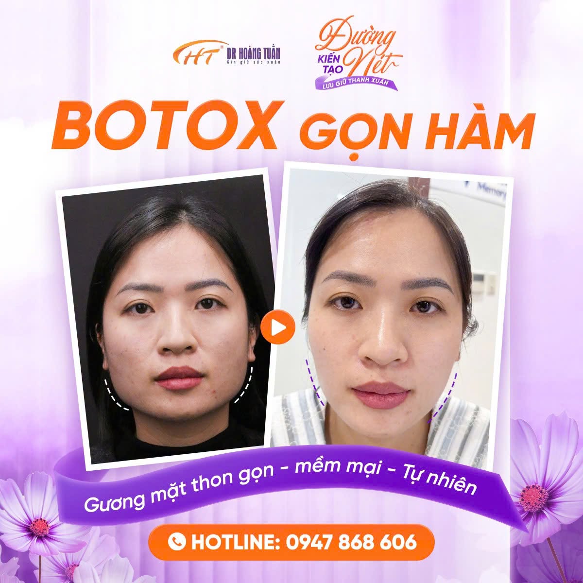 tiêm botox gọn hàm có được nằm nghiêng không