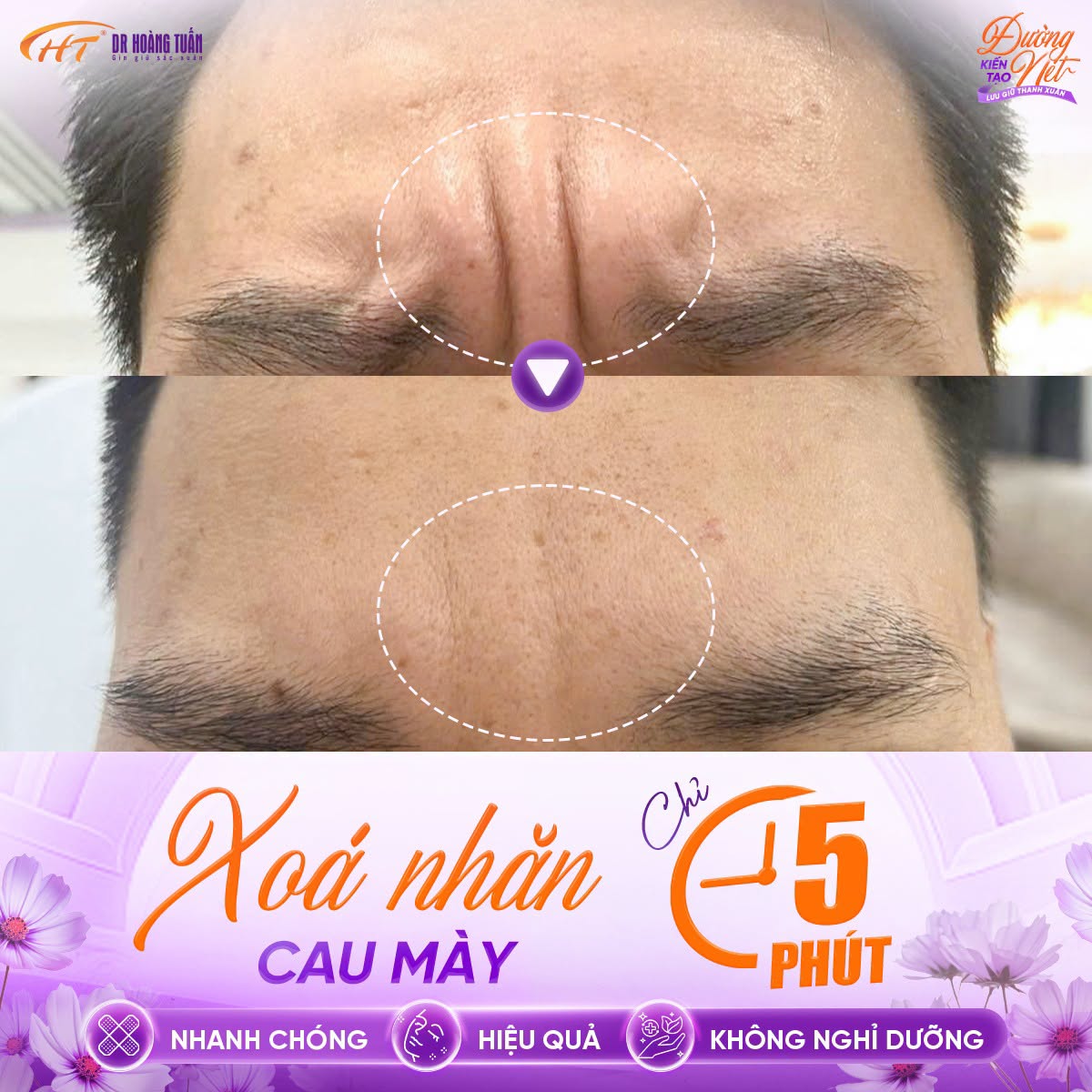 tiêm botox xóa nhăn giữ được bao lâu