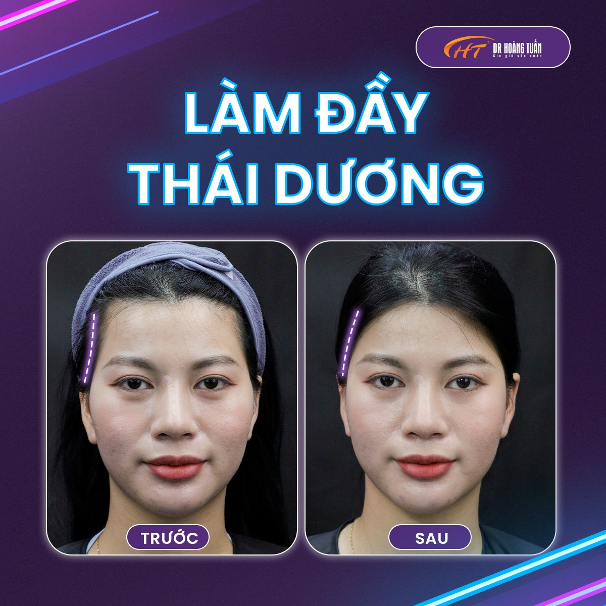 tiêm filler thái dương