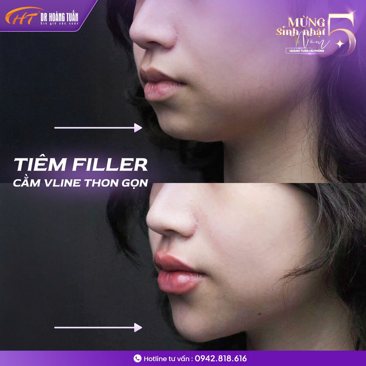 tiêm filler cằm giá bao nhiêu