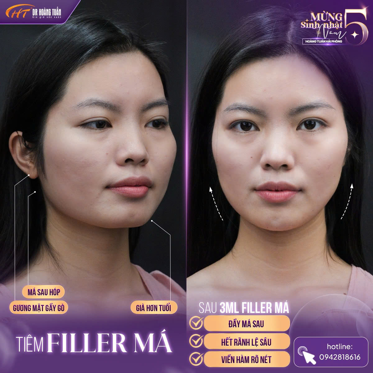 tiêm filler má