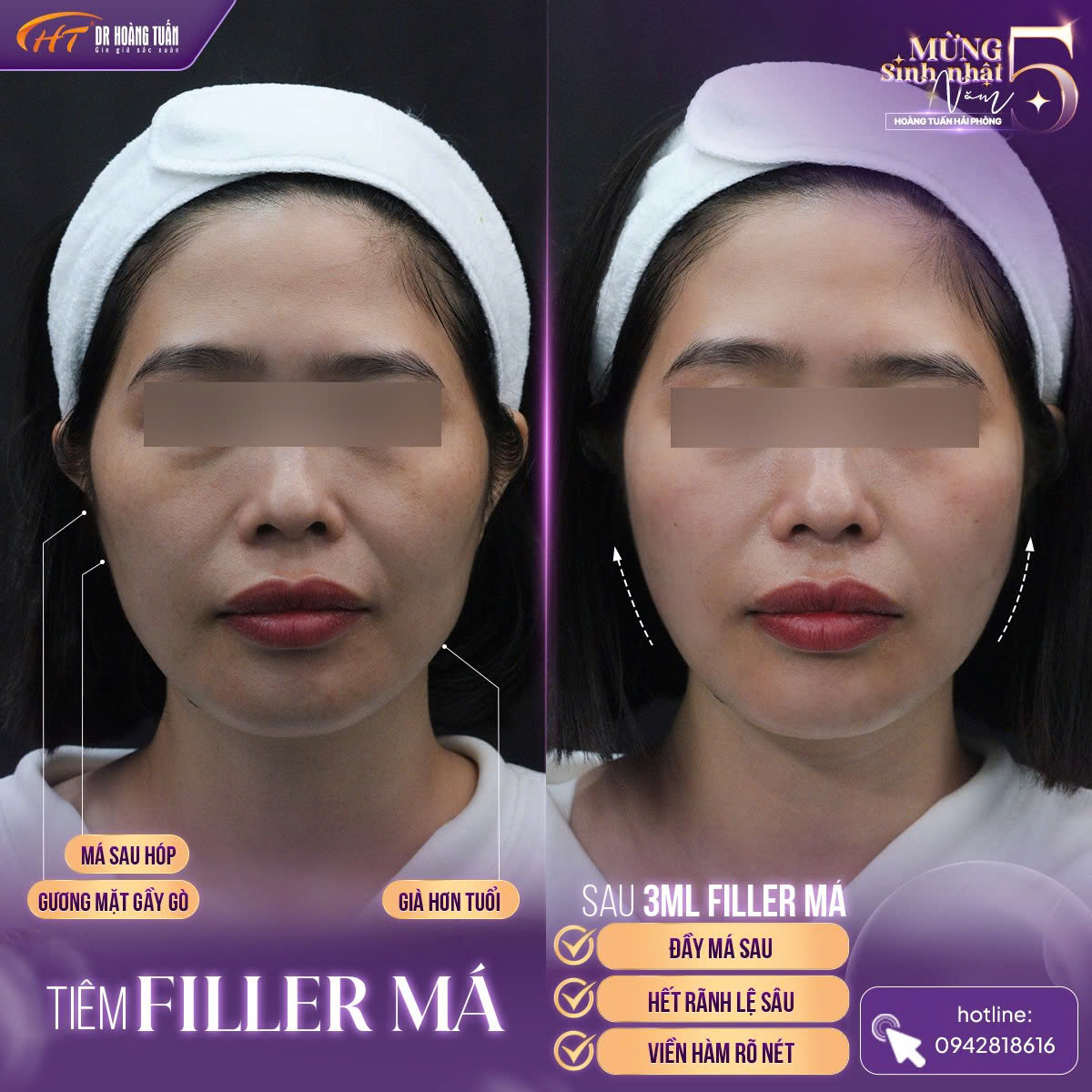 tiêm filler má