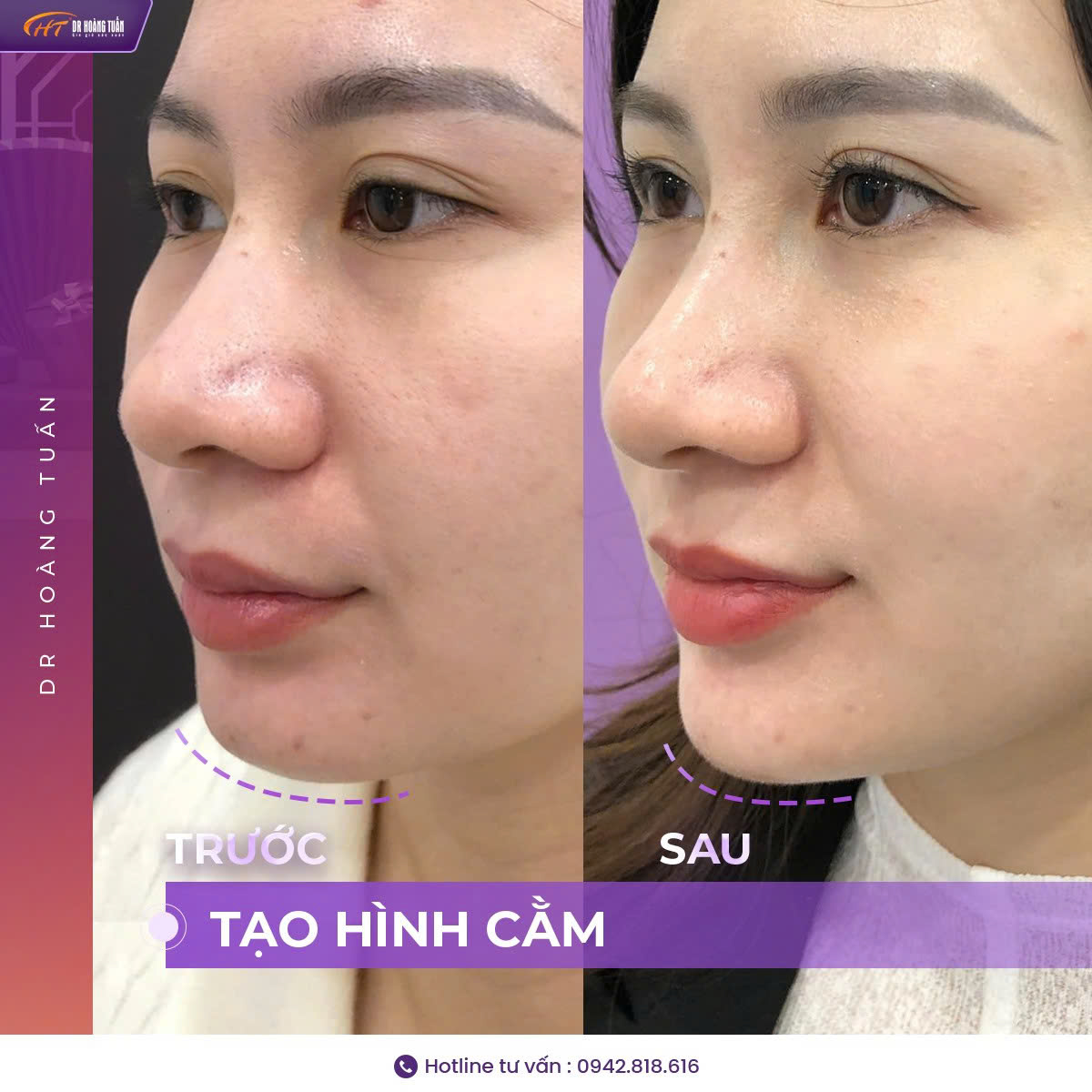 tiêm filler cằm giá bao nhiêu