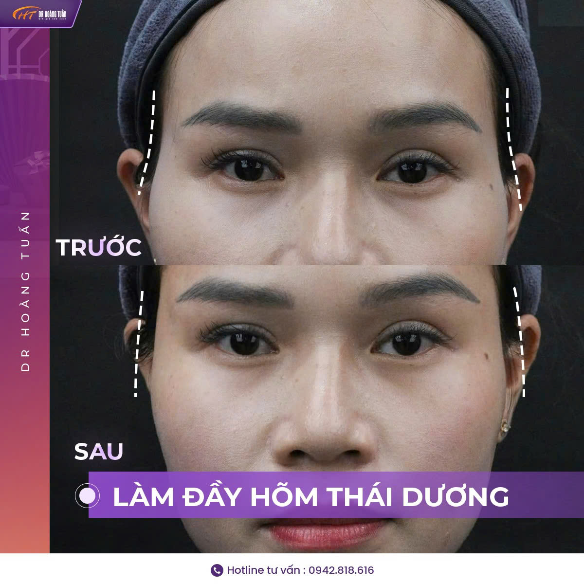 tiêm filler thái dương