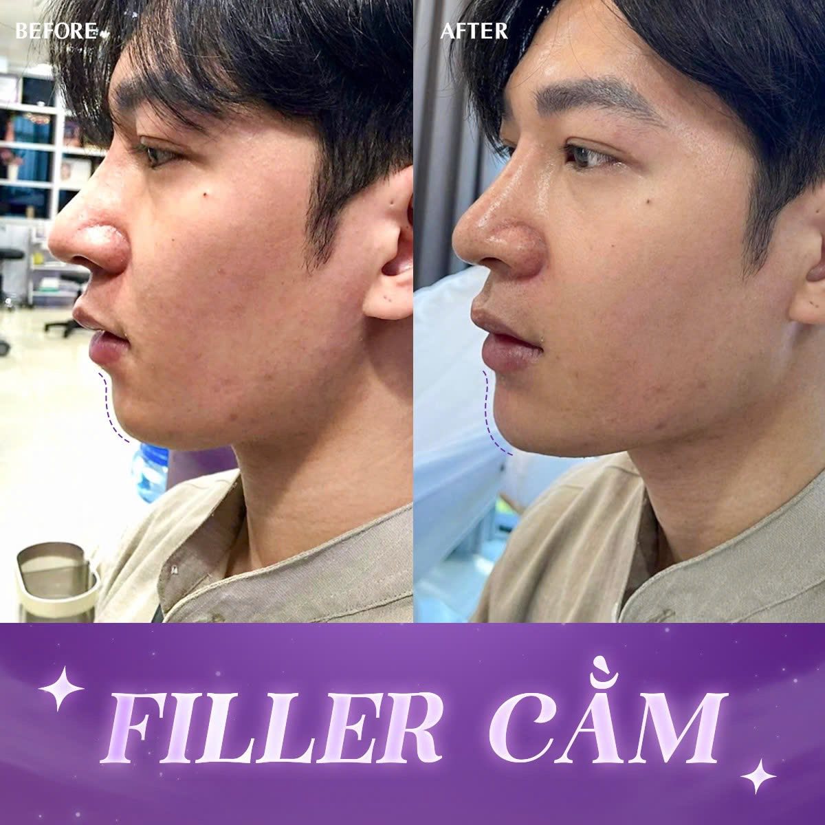 tiêm filler cằm có được nặn mụn không