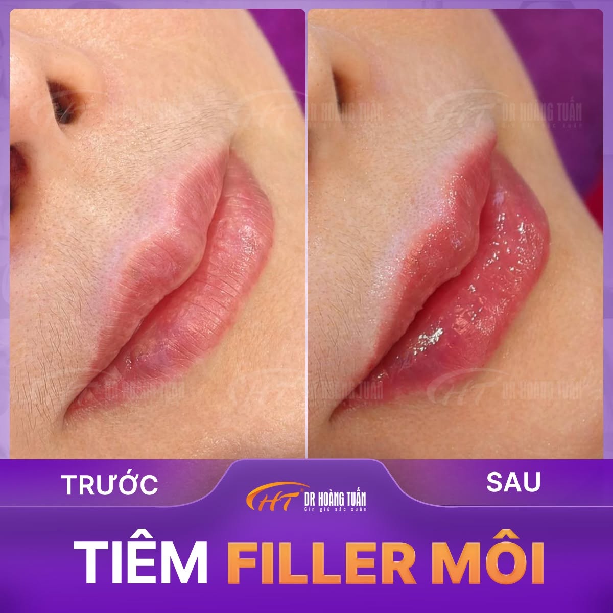 tiêm filler dáng môi tây