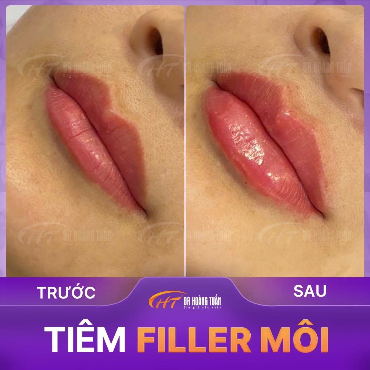 tiêm filler dáng môi tây