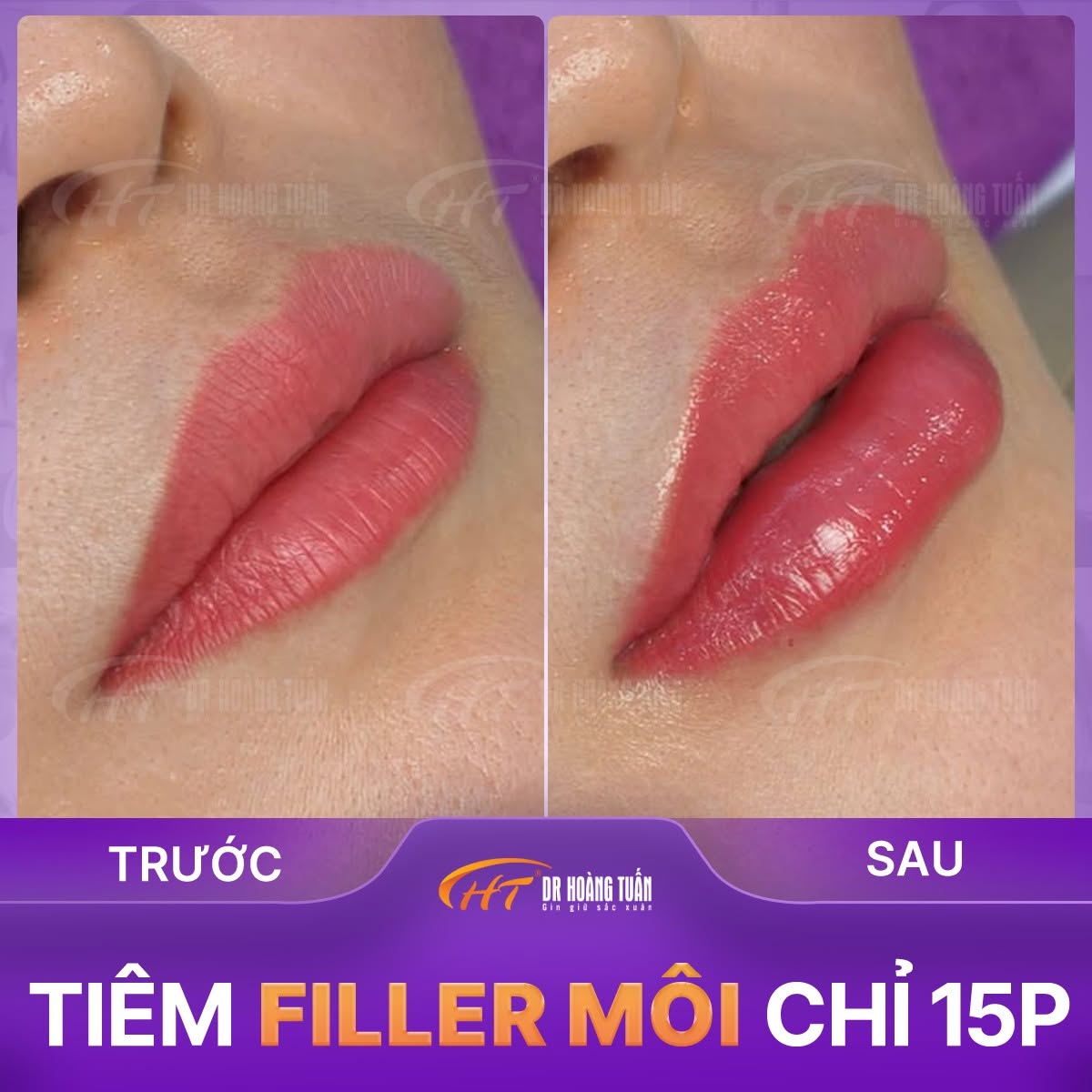 tiêm filler dáng môi tây