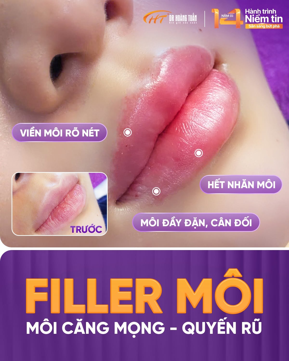 tiêm filler dáng môi tây