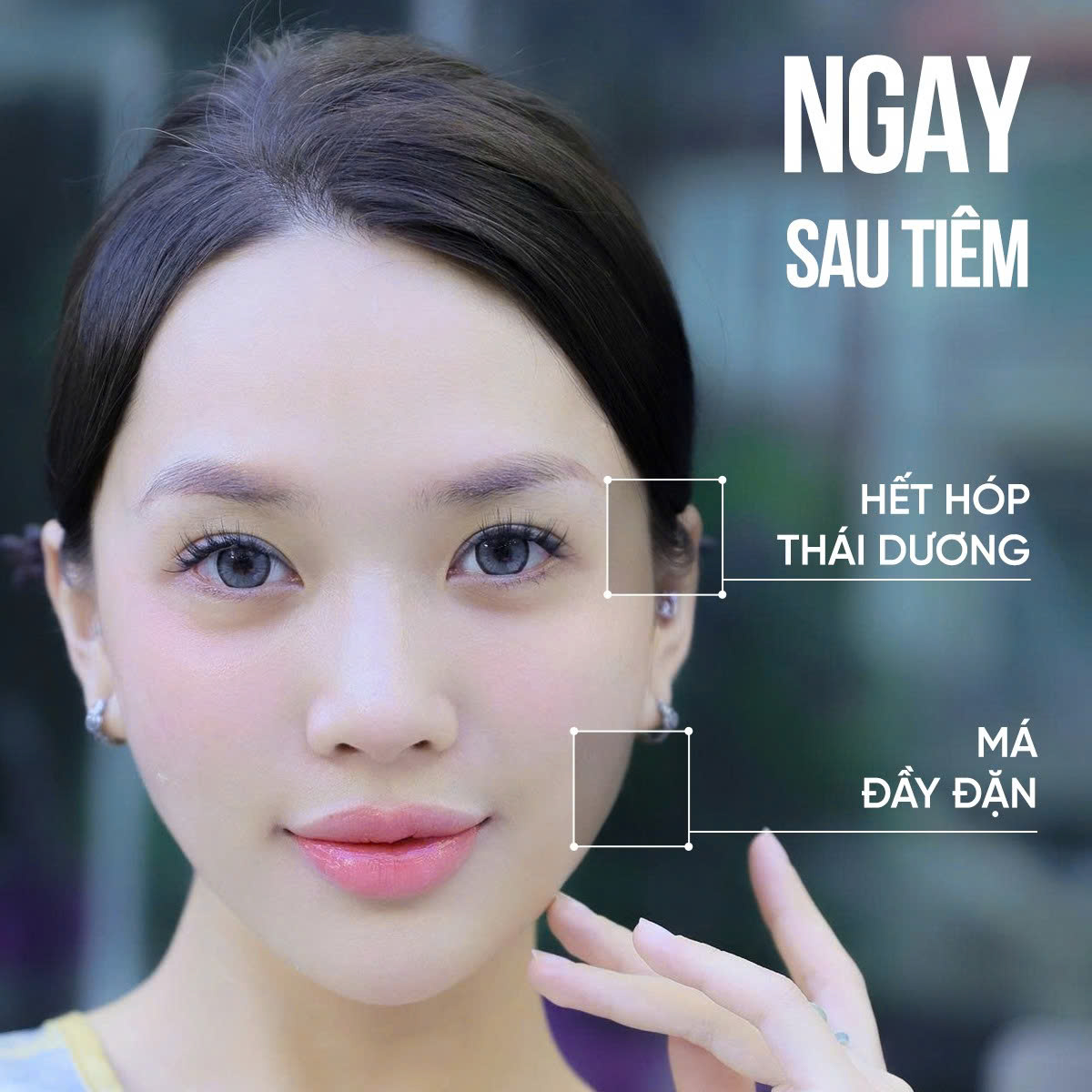 tiêm filler bao lâu thì đẹp
