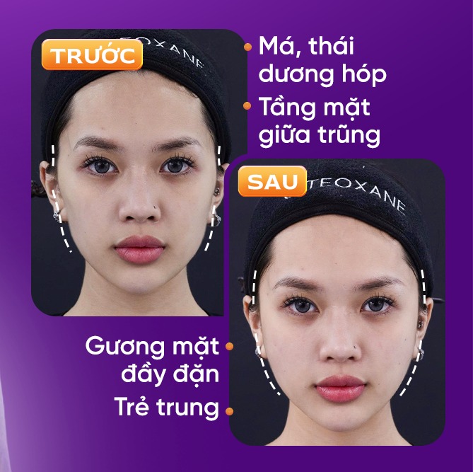 tiêm filler có đau không