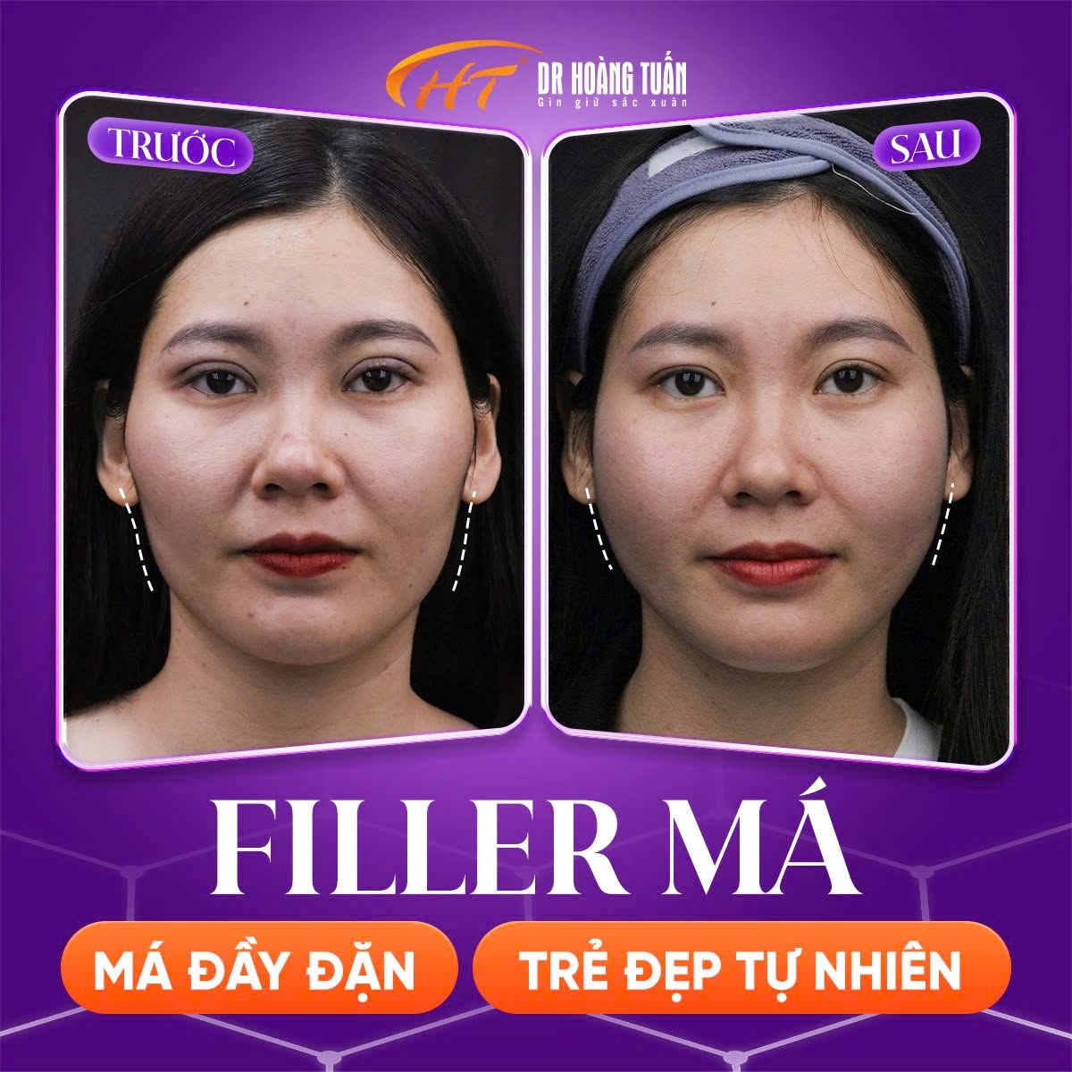 tiêm filler má bao lâu thì vào form