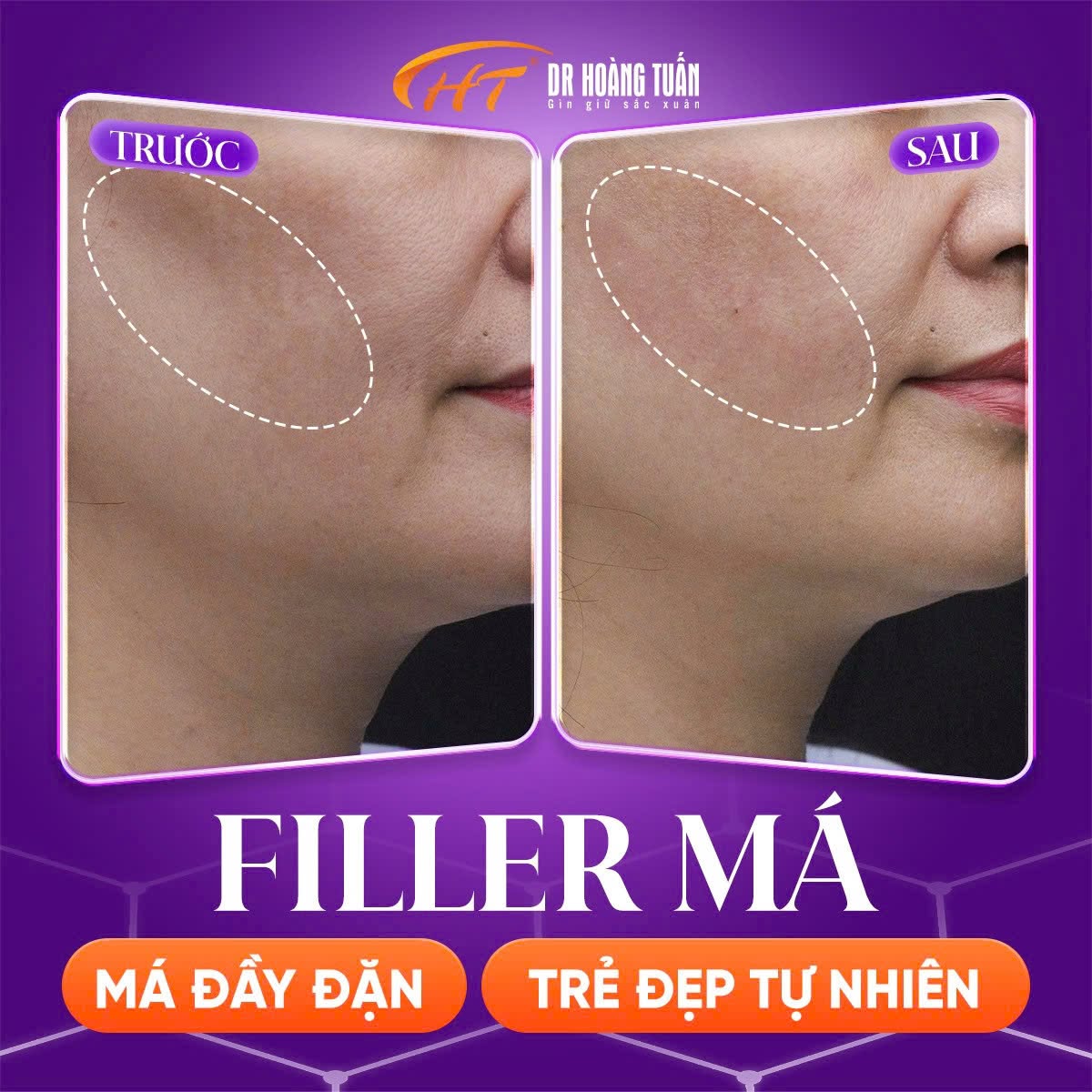 tiêm filler má bao lâu thì vào form