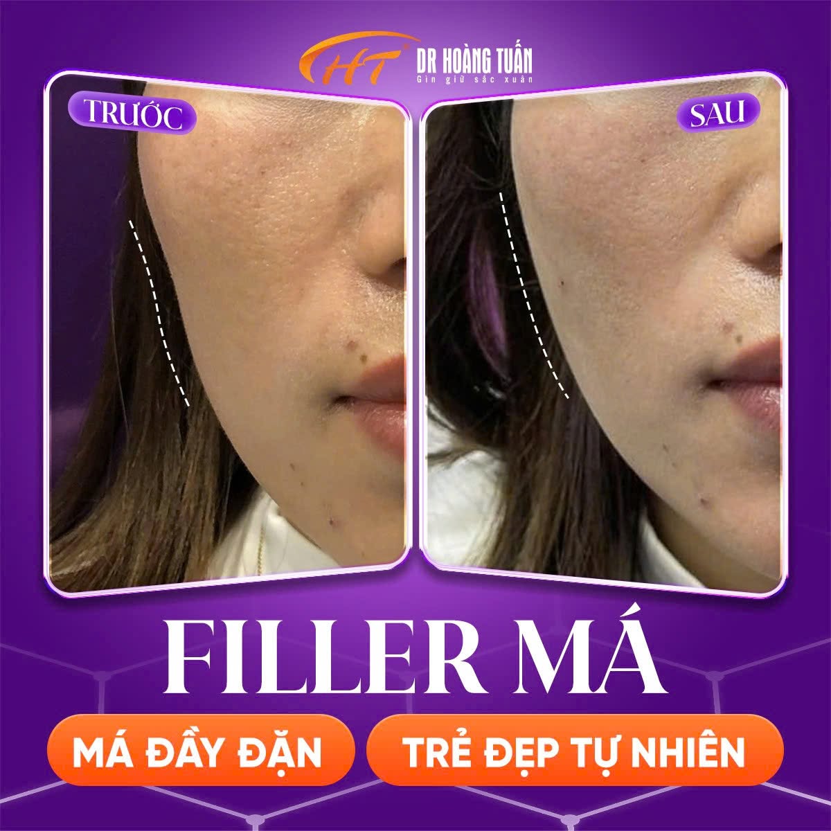 tiêm filler má bao lâu thì vào form