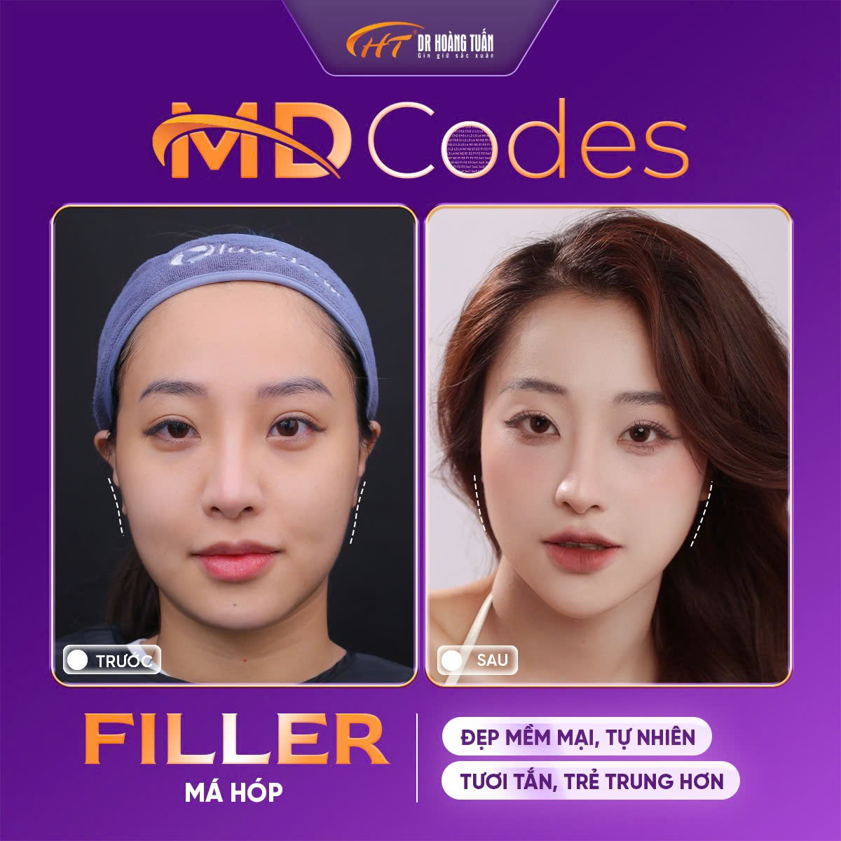 tiêm filler có an toàn không