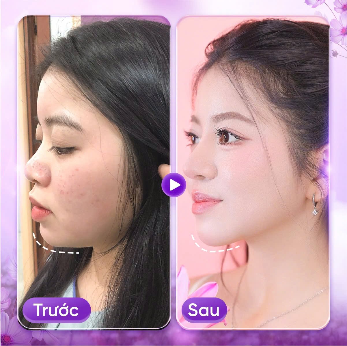 Tiêm filler cằm bao lâu thì vào form
