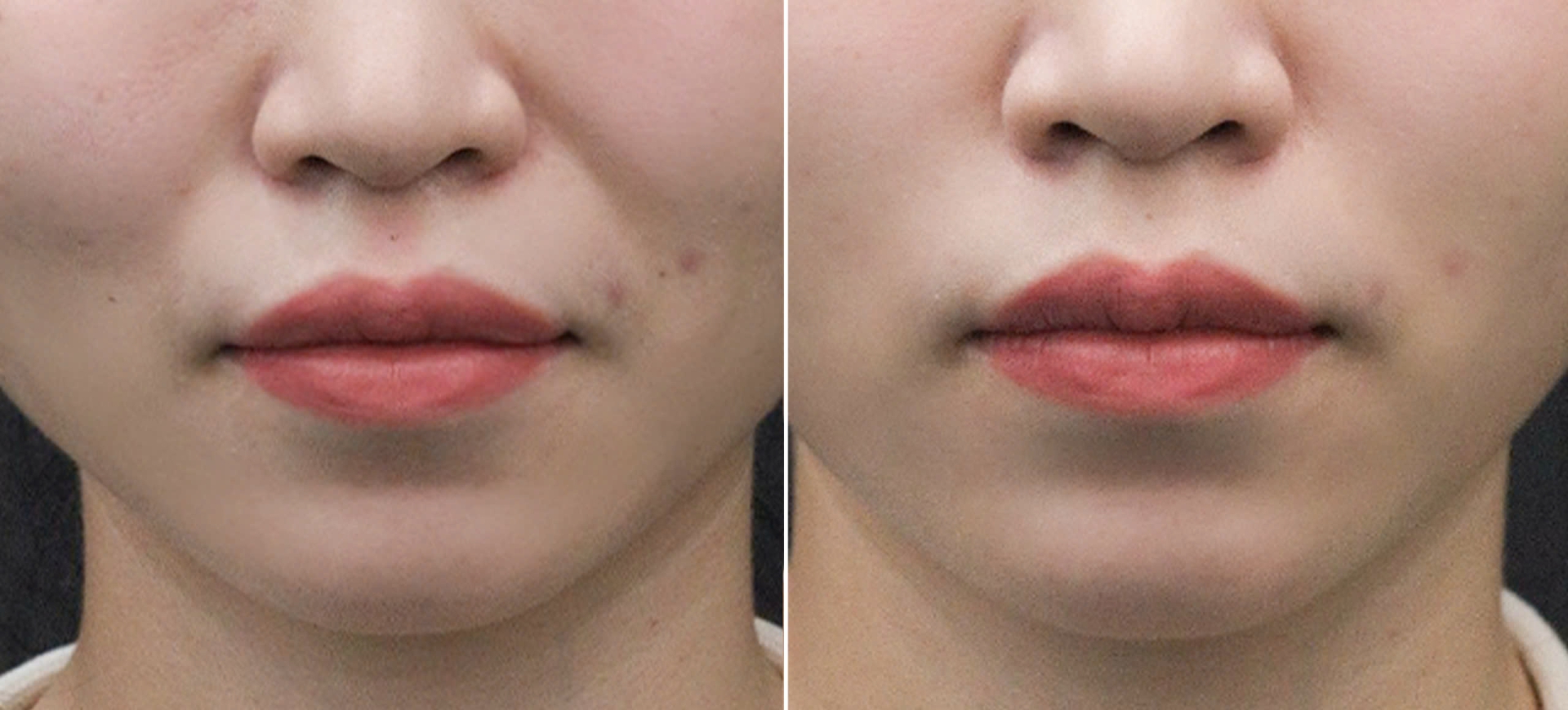 tiêm filler môi có ảnh hưởng gì không