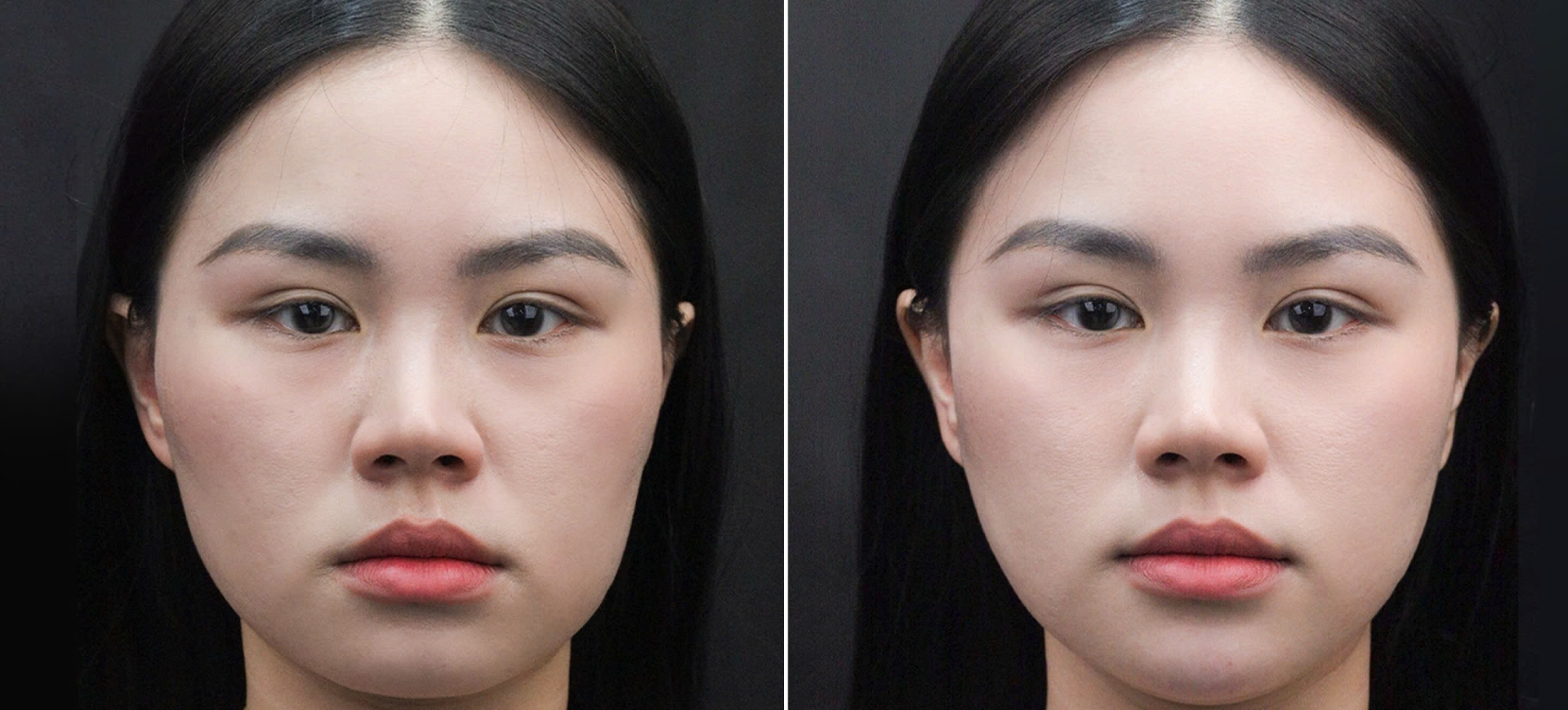 Tiêm HA Và Filler Khác Nhau Như Thế Nào