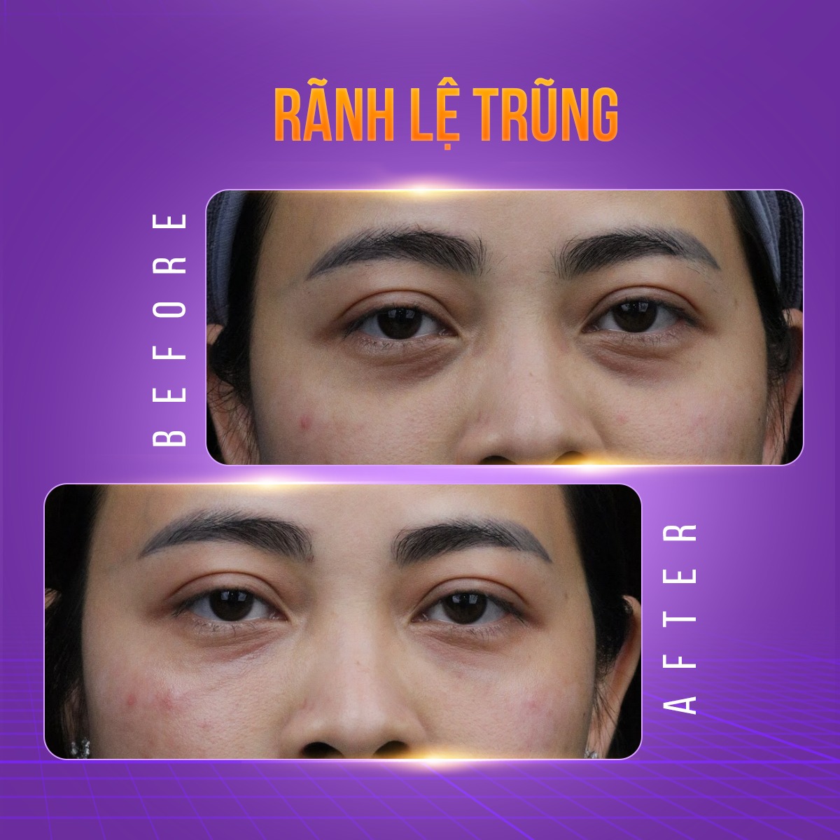 tiêm ha làm đầy hốc mắt
