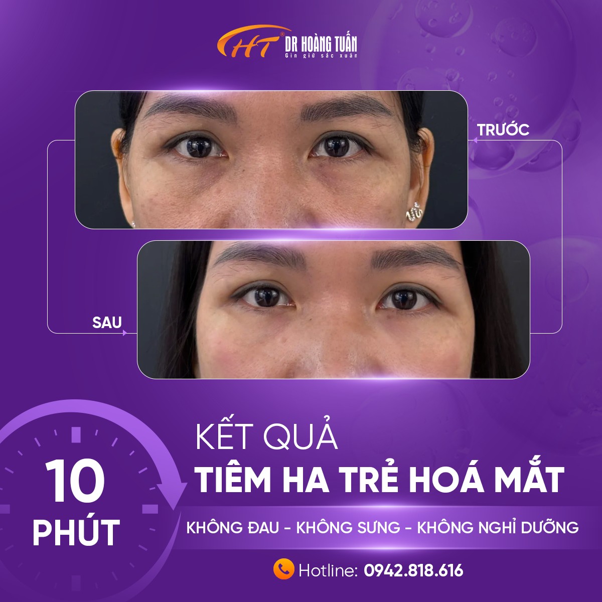 tiêm ha trị thâm quầng mắt giá bao nhiêu