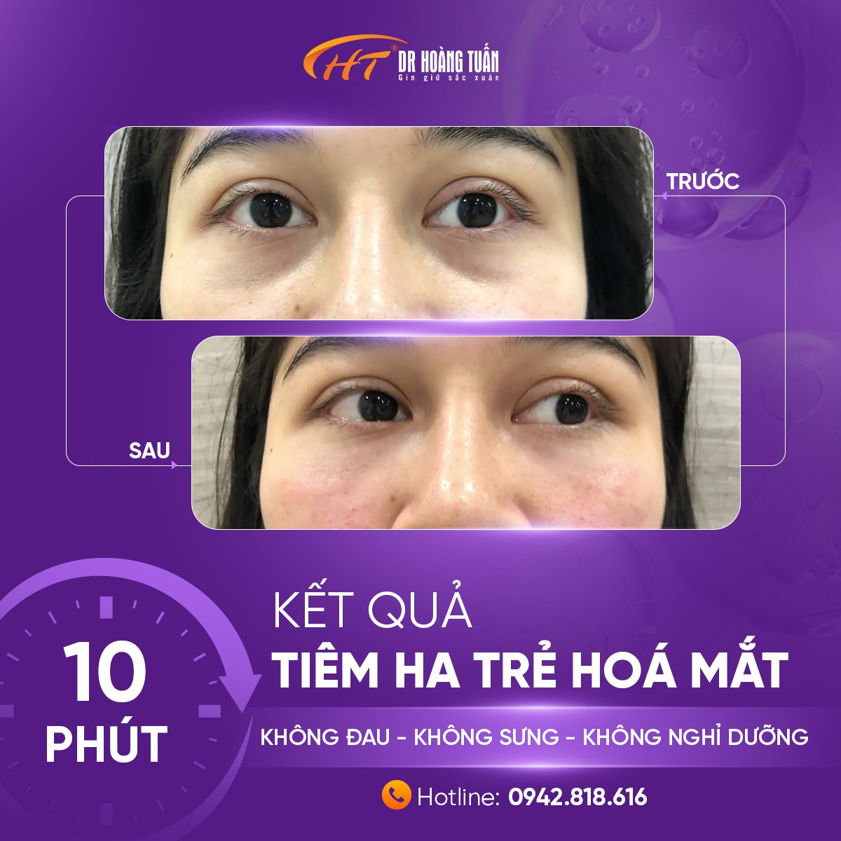 tiêm ha trị thâm quầng mắt
