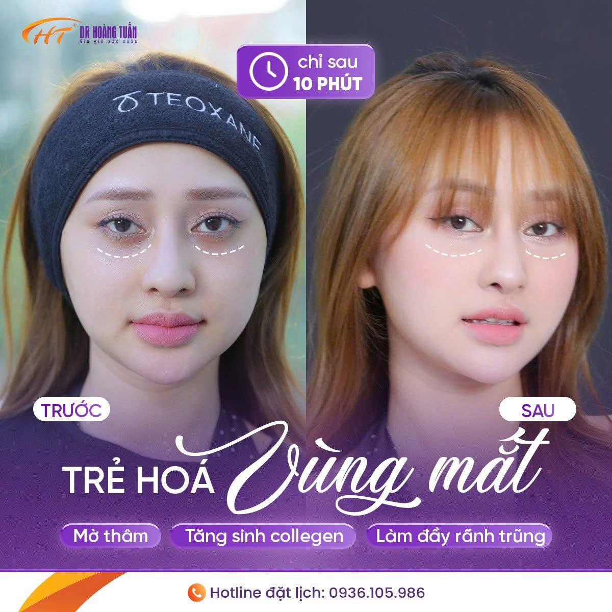 tiêm ha trị thâm quầng mắt