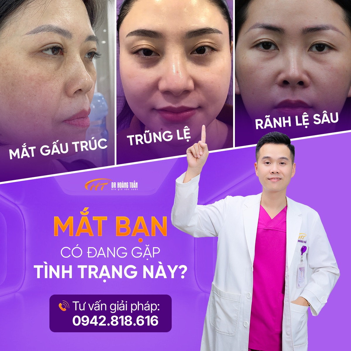 tiêm ha trị thâm quầng mắt