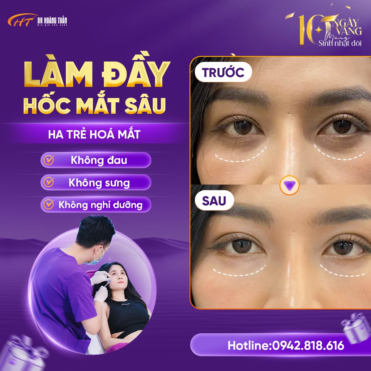 tiêm ha làm đầy hốc mắt