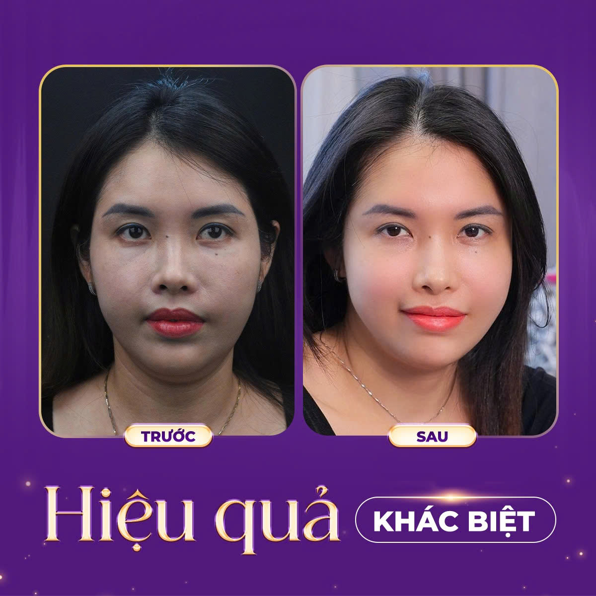 tiêm meso bao lâu thì đẹp