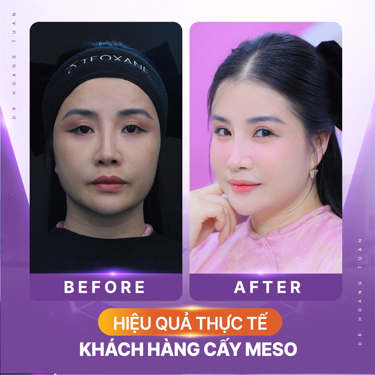 địa chỉ tiêm meso uy tín