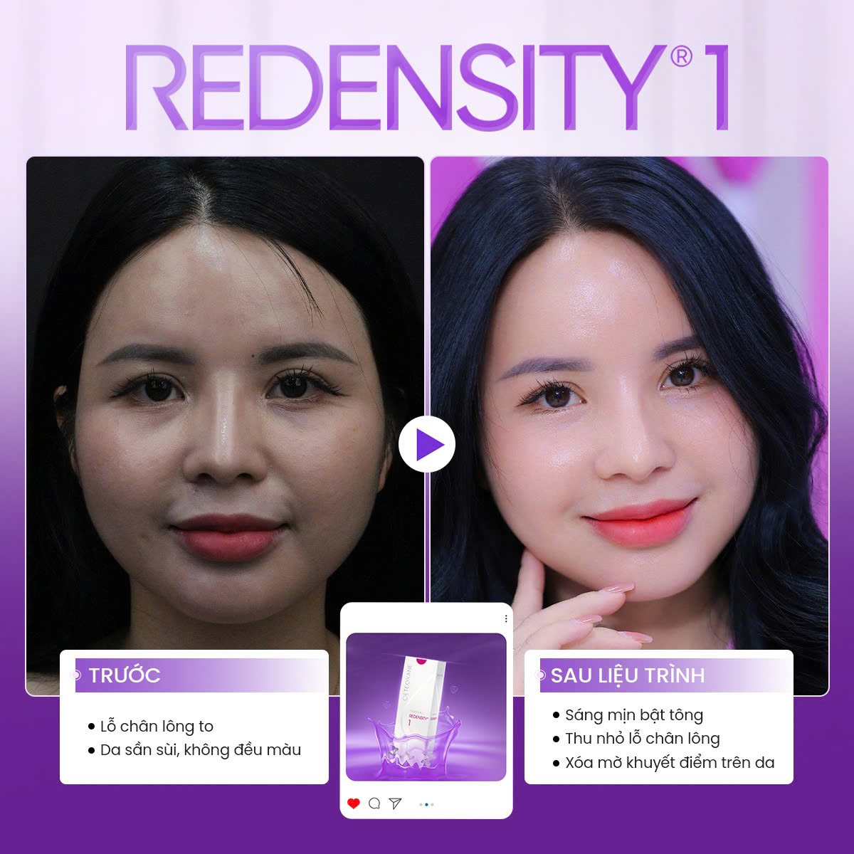 tiêm meso cần kiêng gì