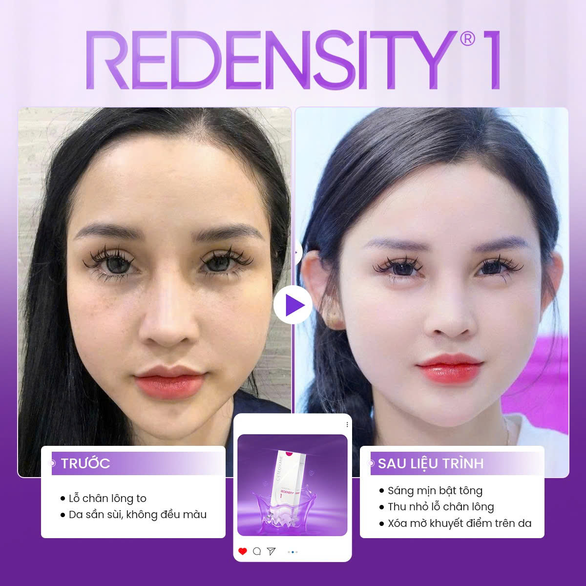 địa chỉ tiêm meso uy tín