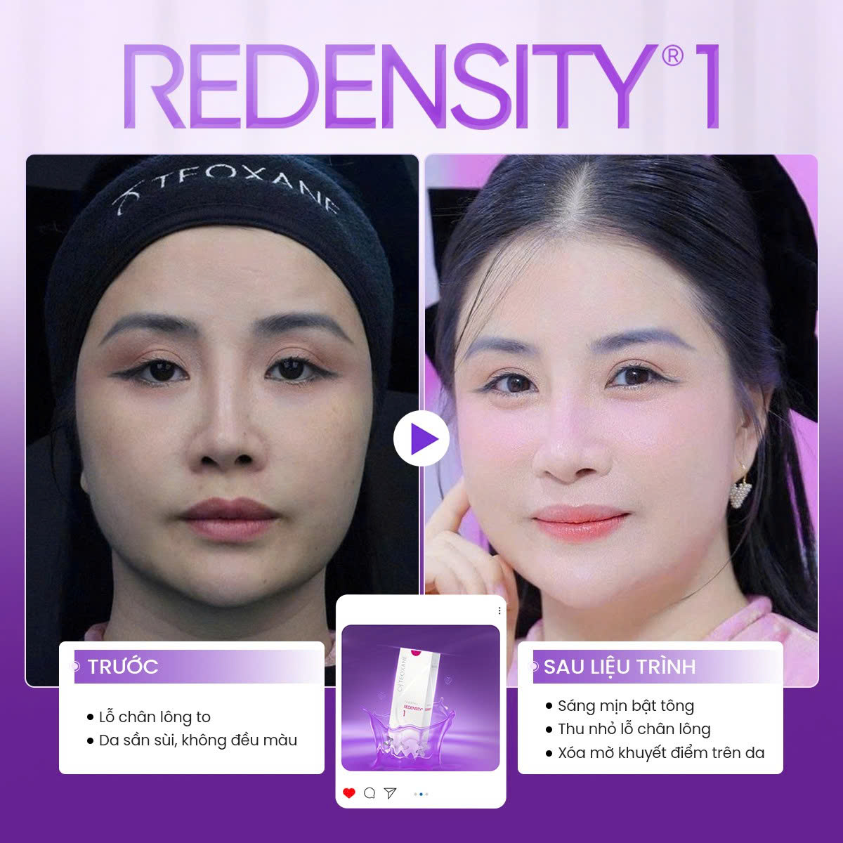 tiêm meso cần kiêng gì