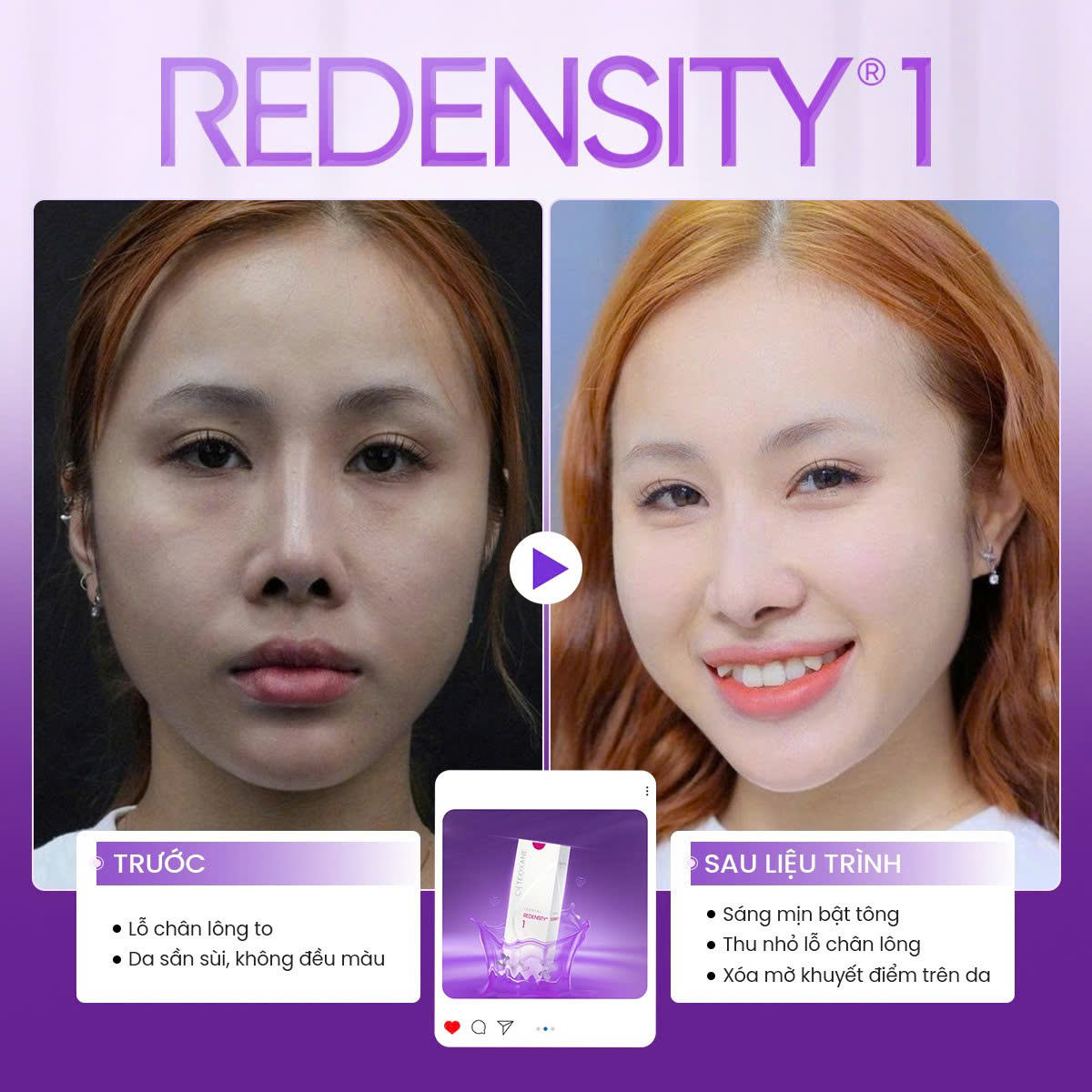 tiêm meso bao lâu thì đẹp