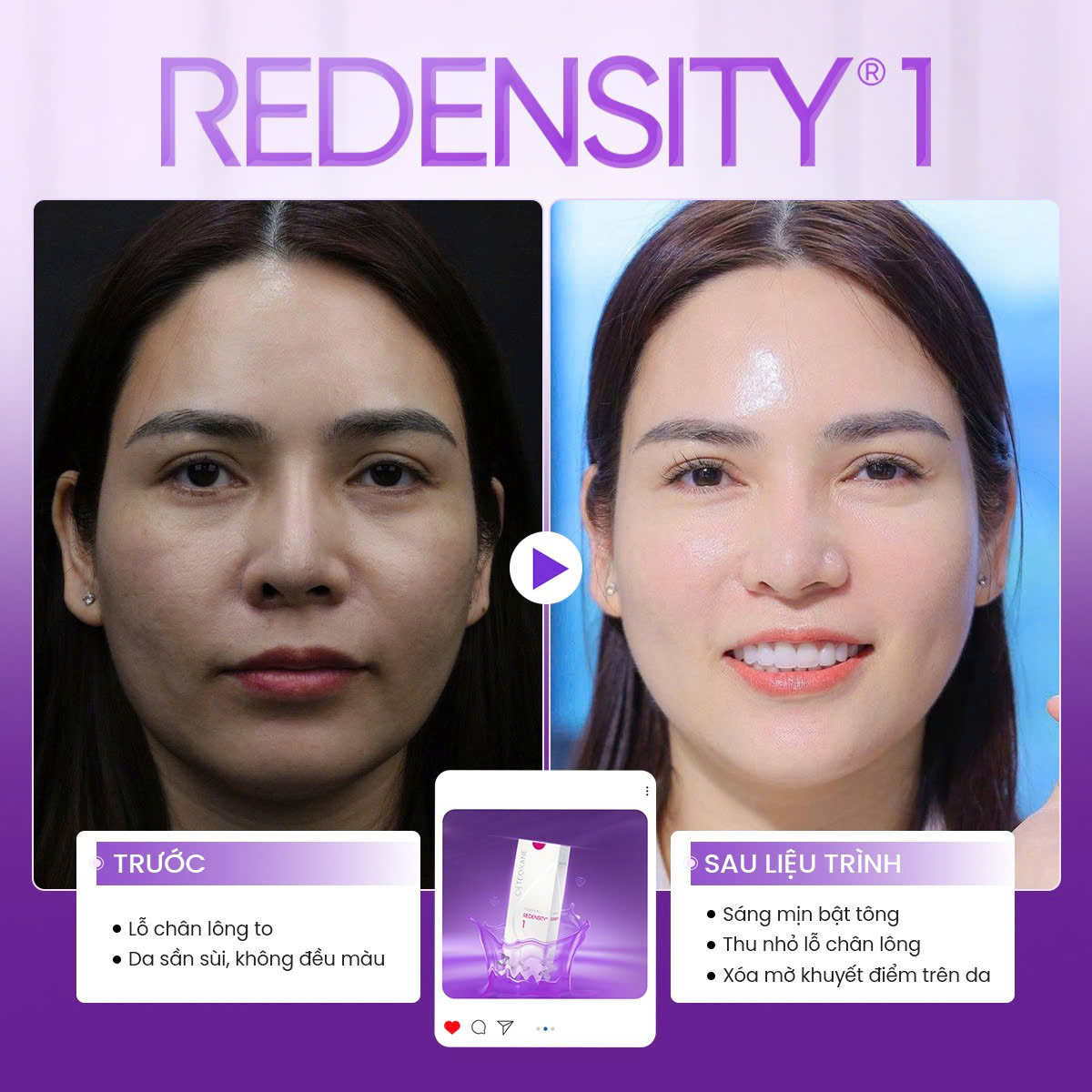 tiêm meso và botox khác nhau như thế nào