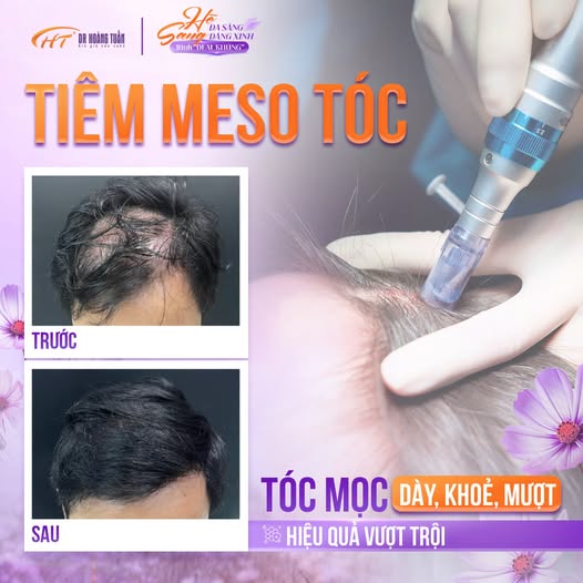 tiêm meso tóc