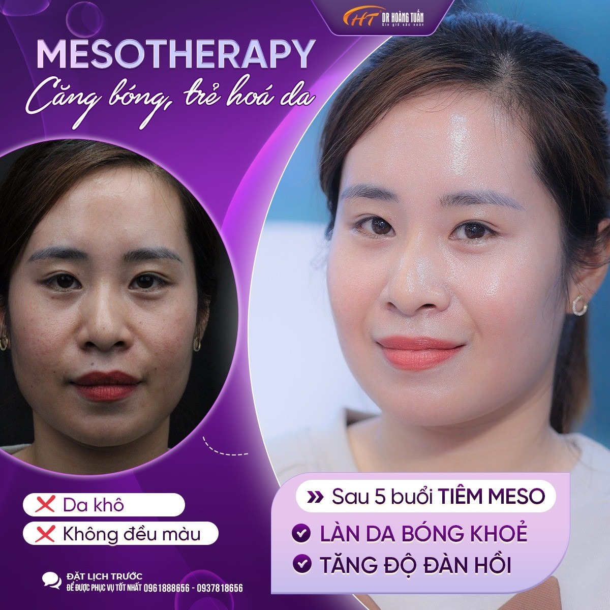 tiêm meso bao lâu thì bôi kem chống nắng