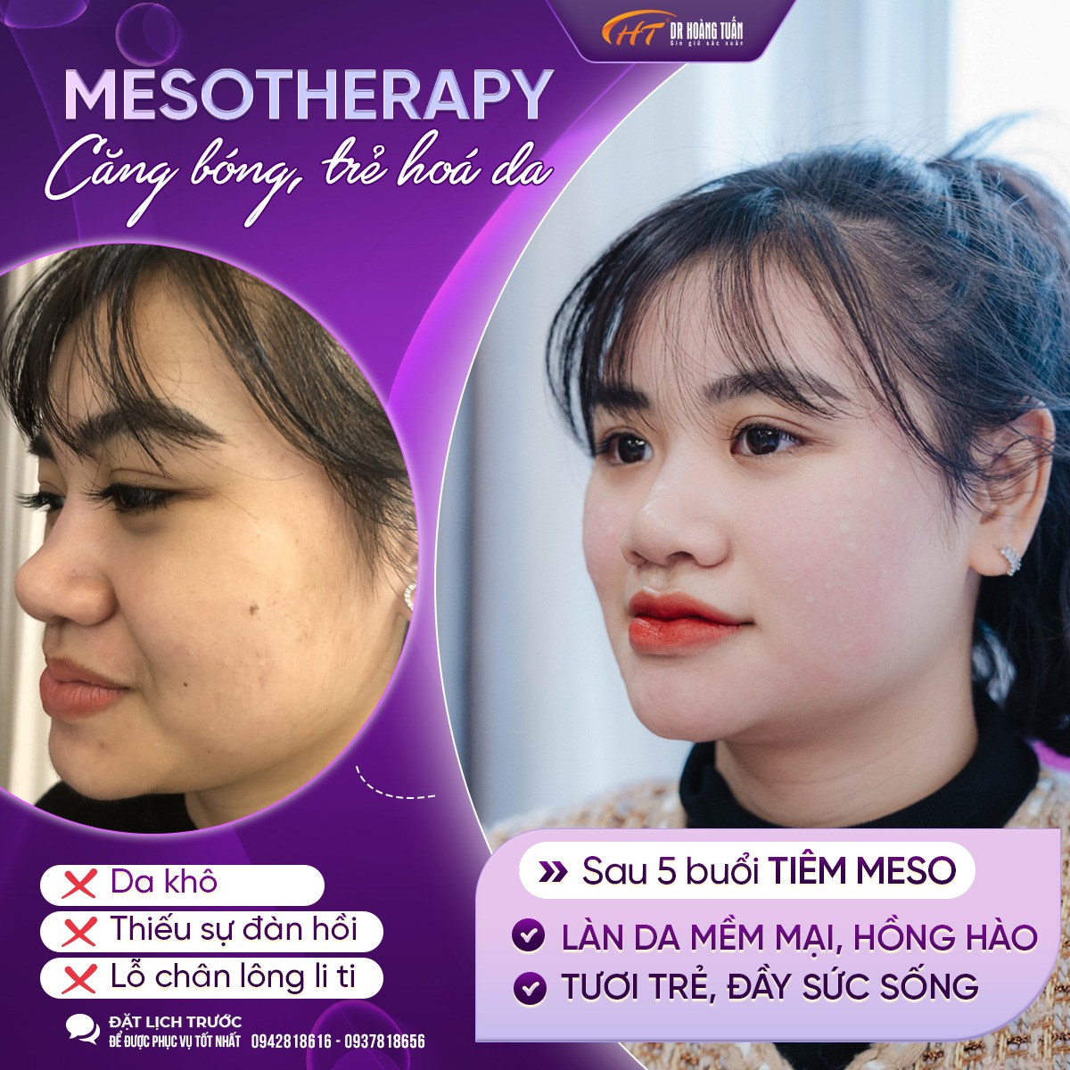 tiêm meso mấy lần thì đẹp