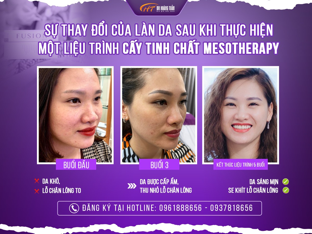 tiêm meso có đau không