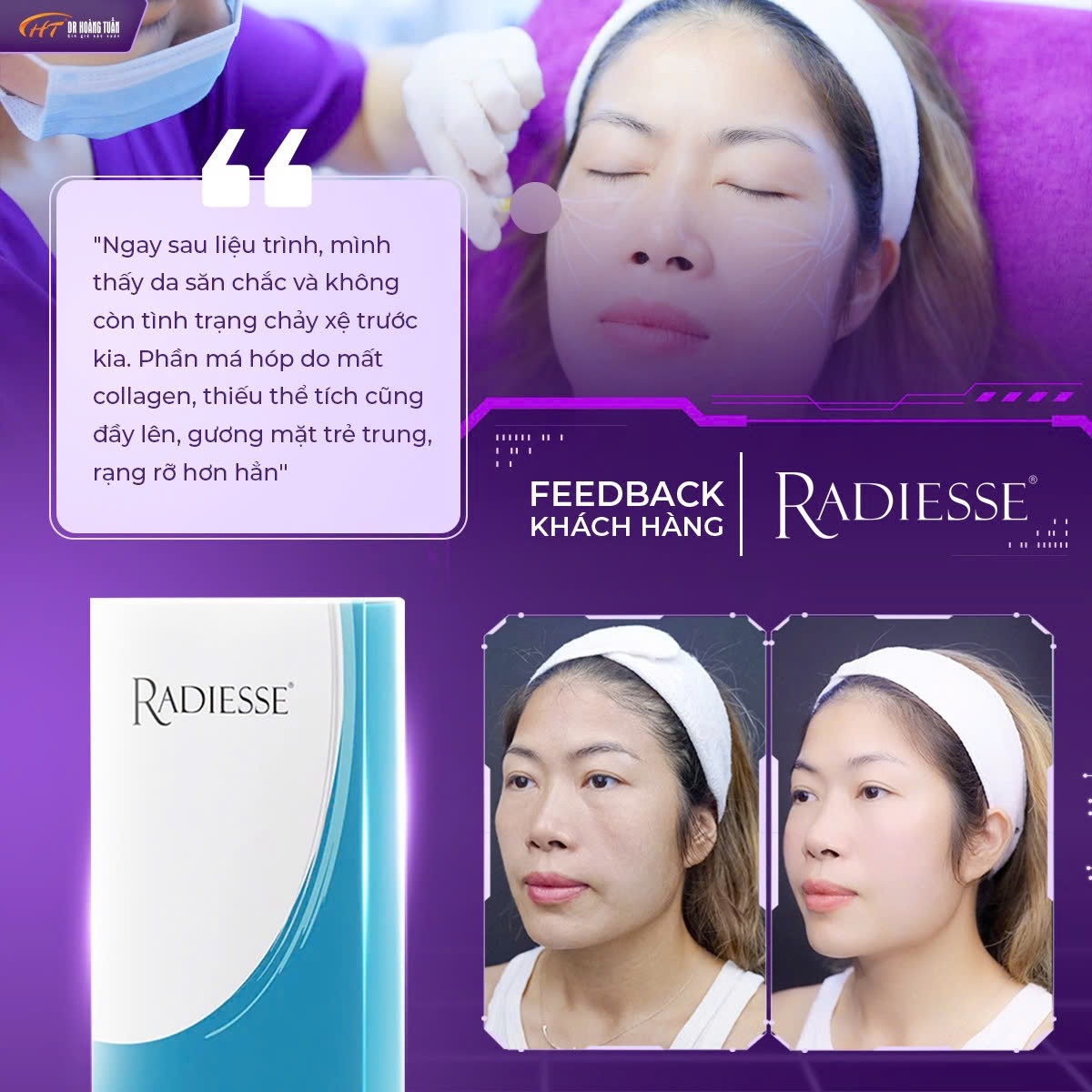 Tiêm Radiesse 