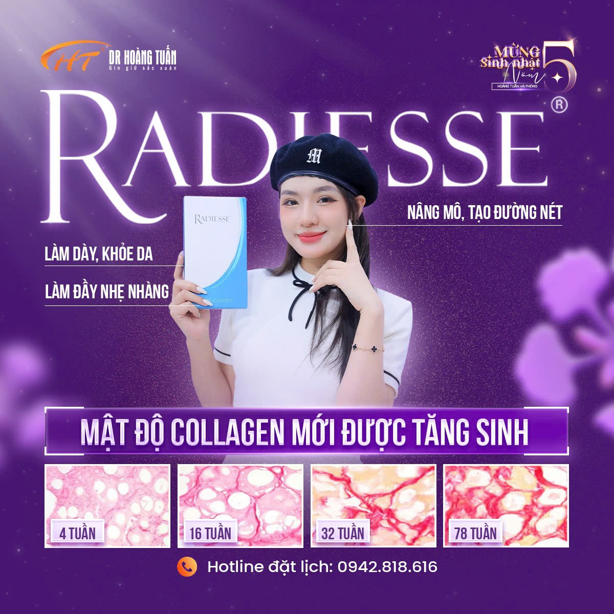 tiêm radiesse có tác dụng gì