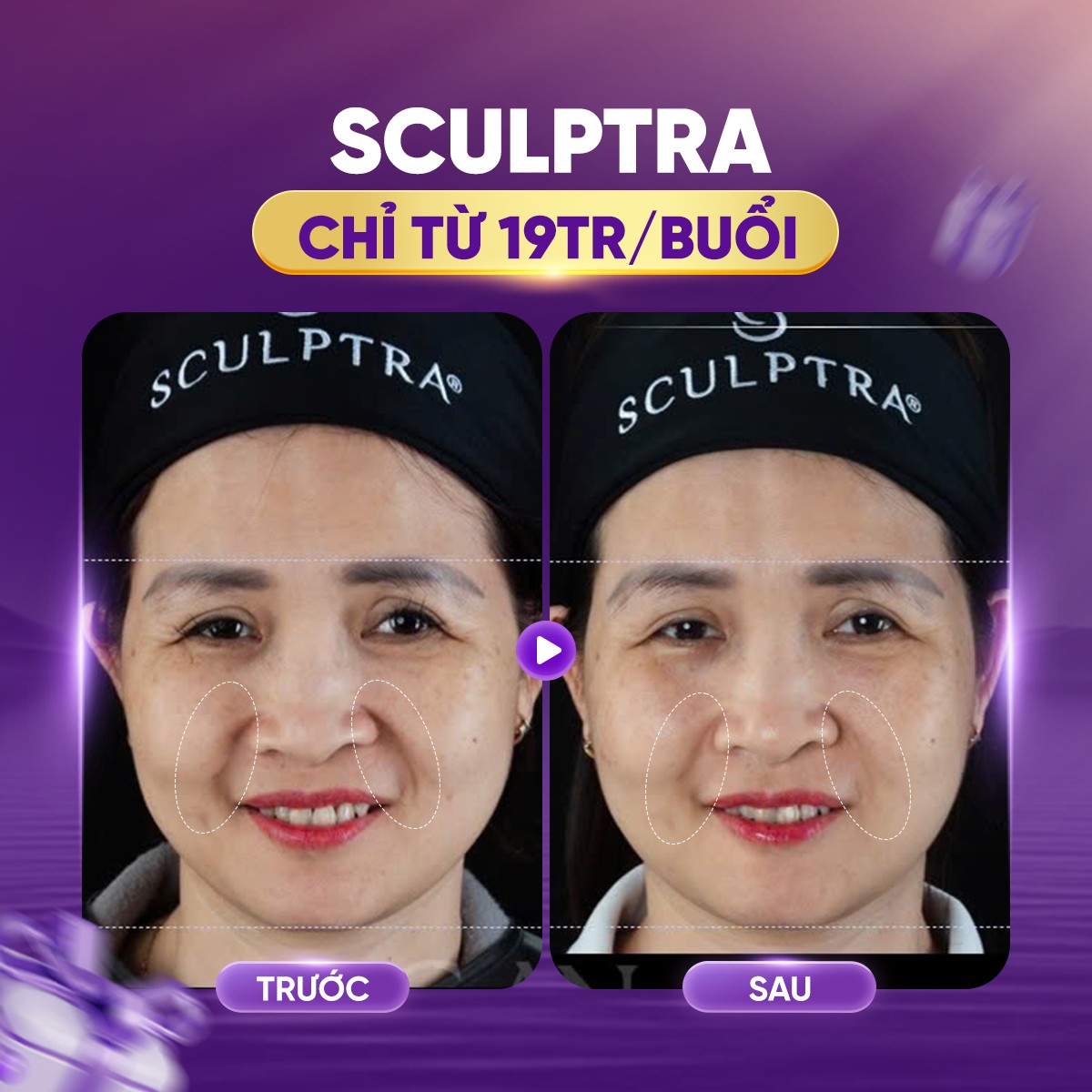 tiêm sculptra