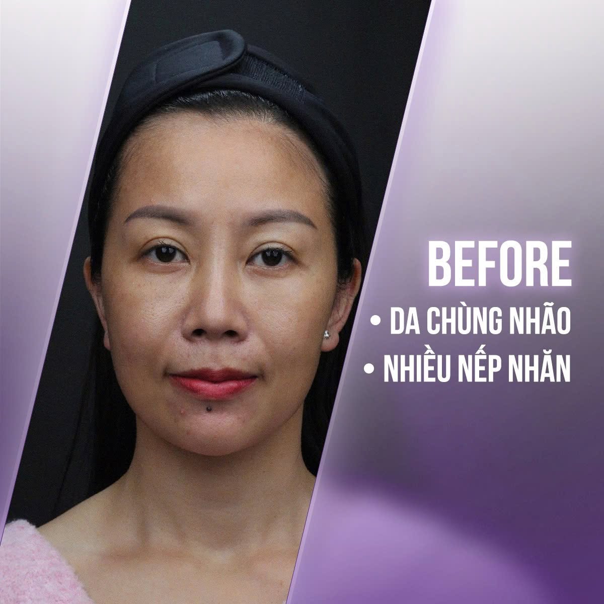 trẻ hóa da vùng cổ