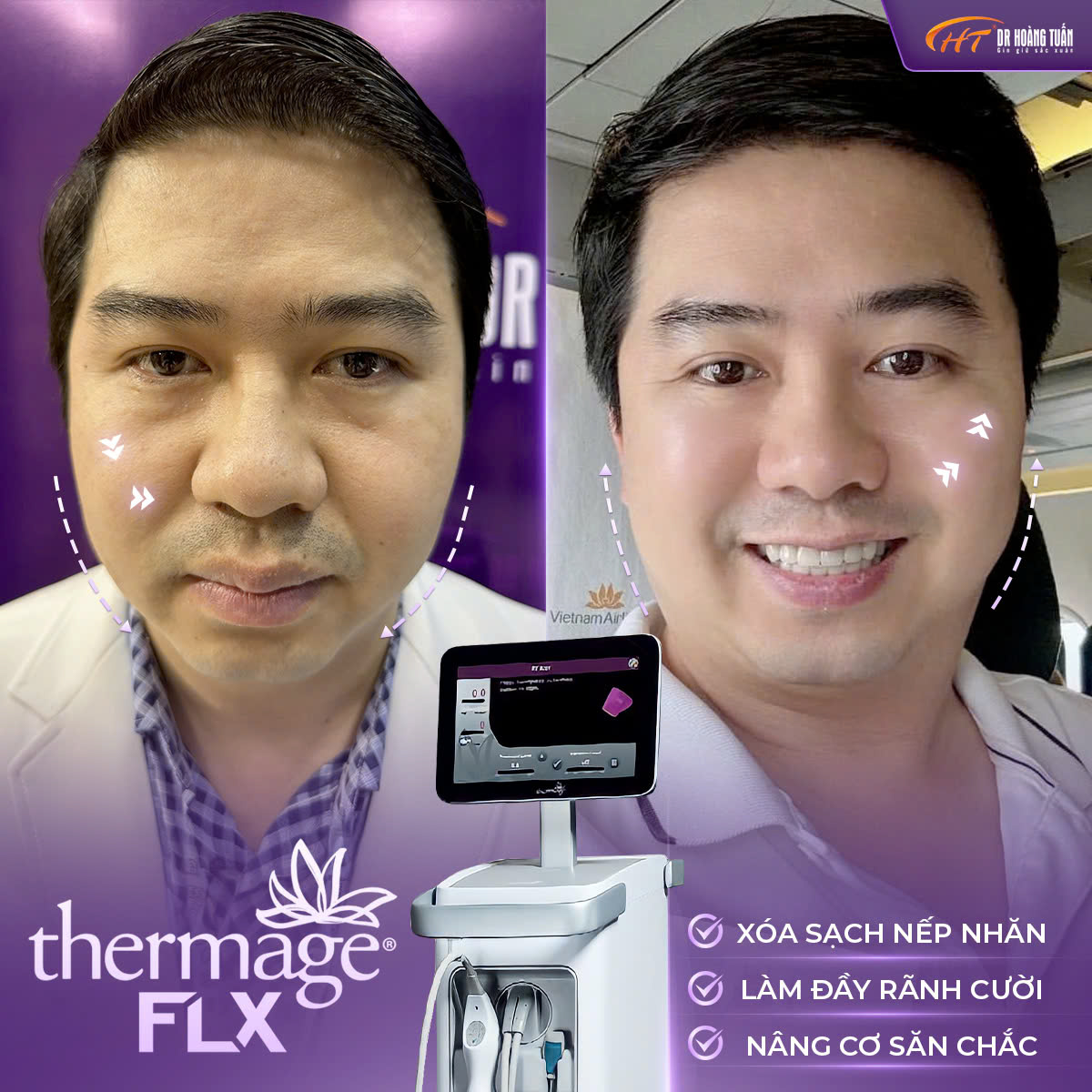 Thermage FLX có đau không