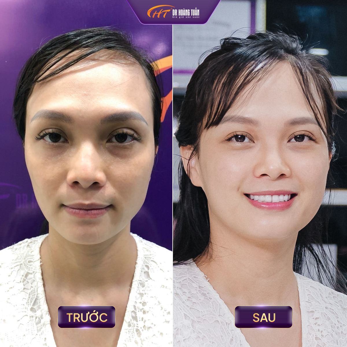 thermage flx có tốt không