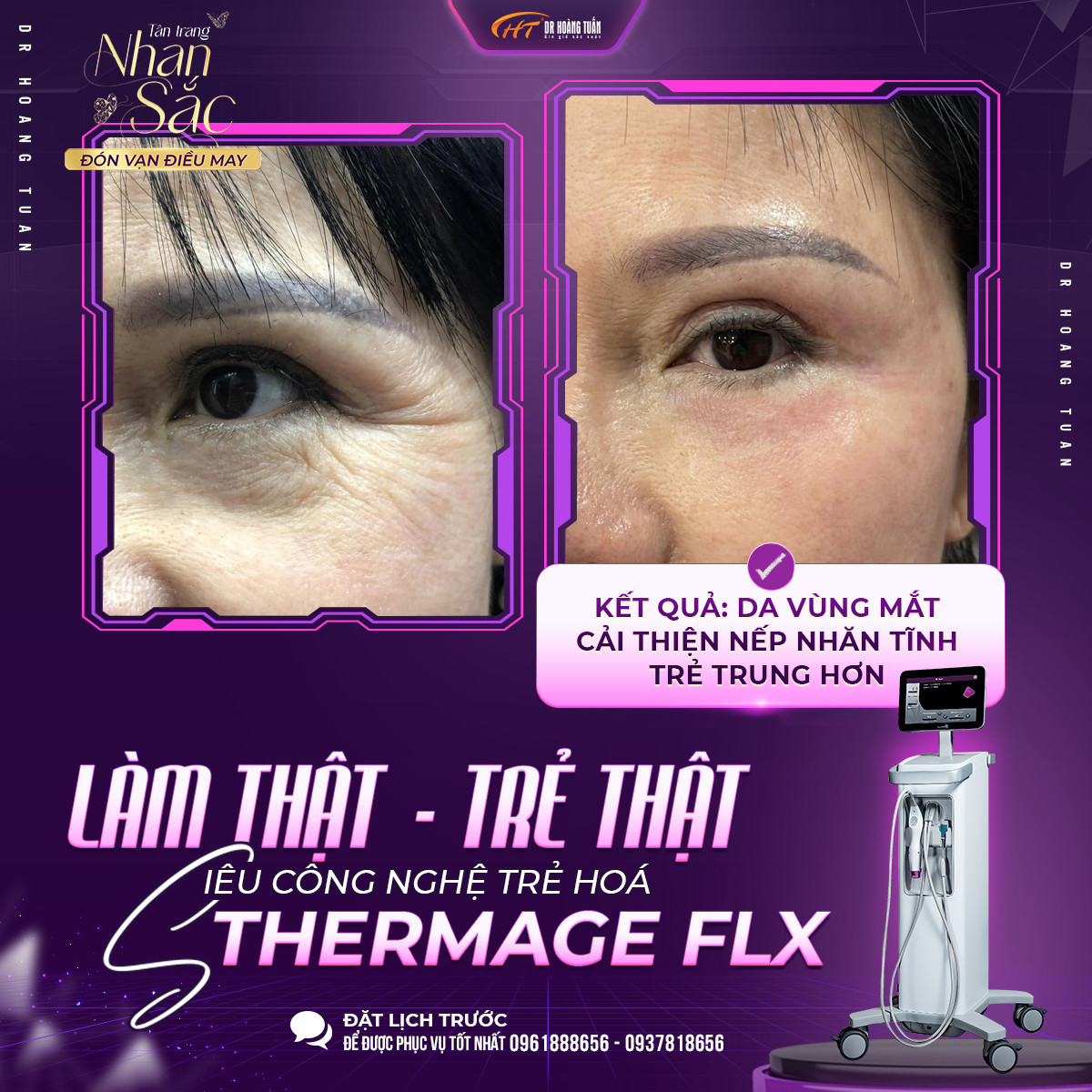 thermage flx mắt