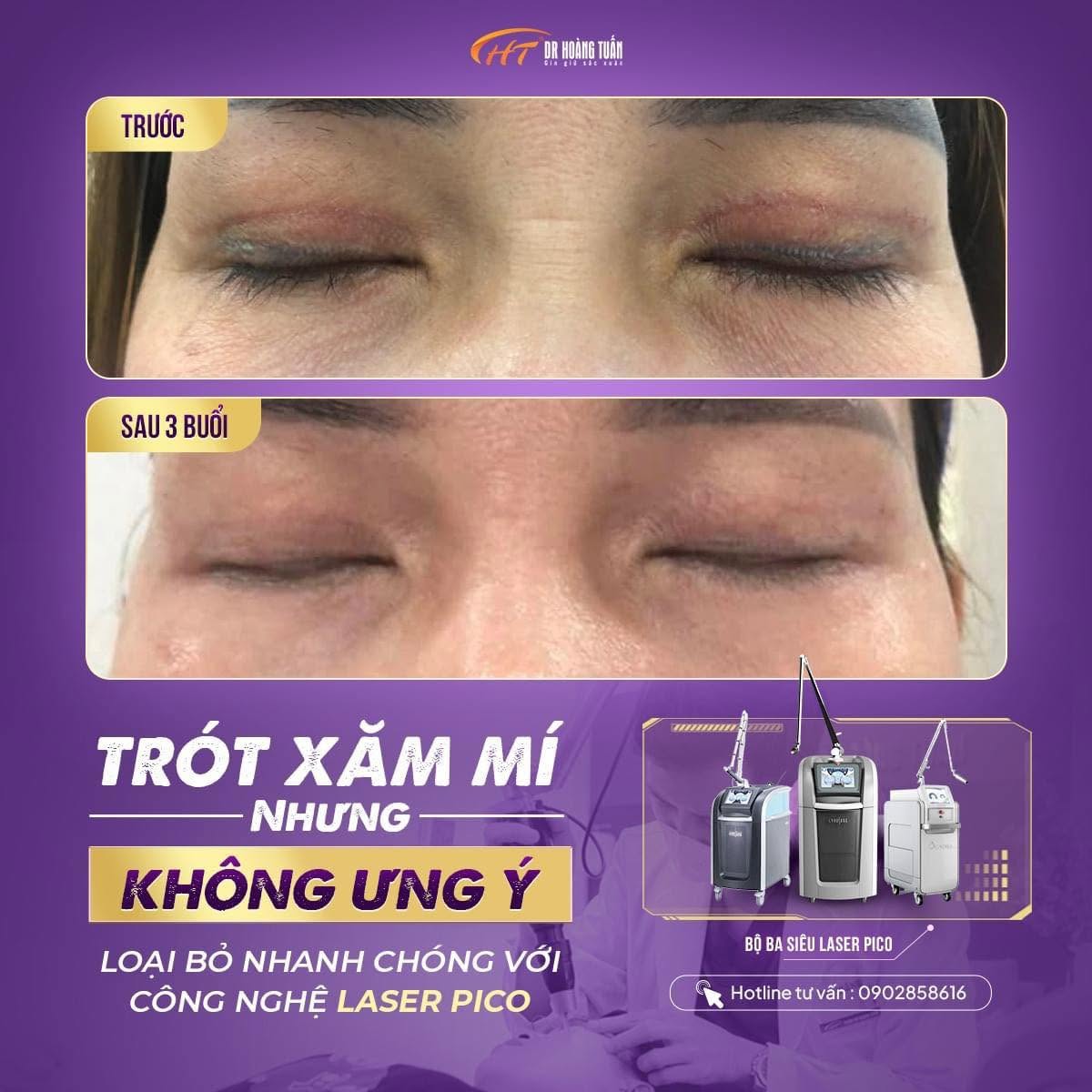 xoá xăm mí mắt