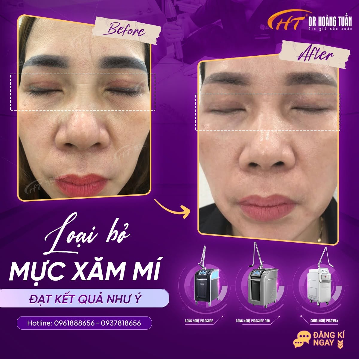 xoá xăm mí mắt