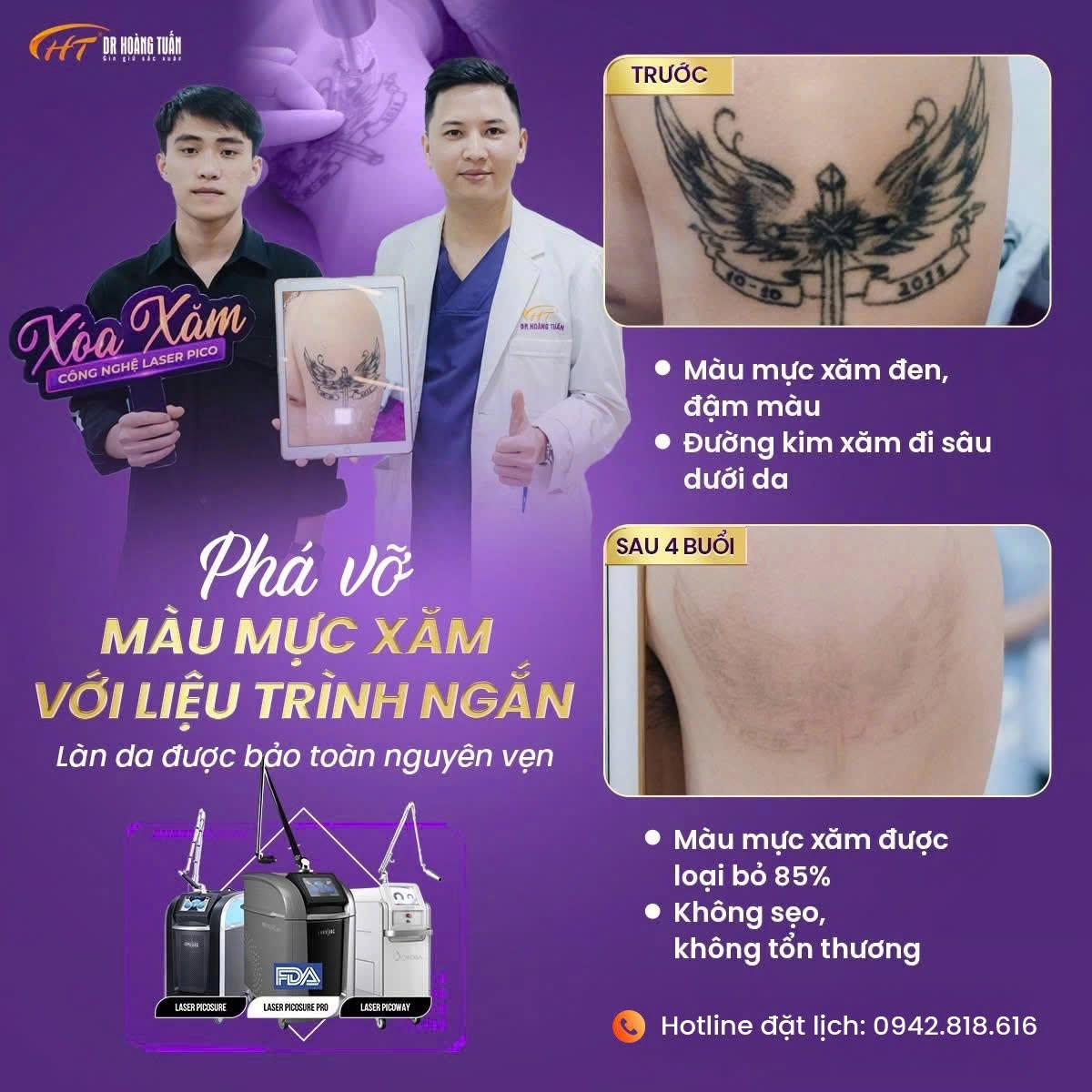xóa xăm laser có tốt không