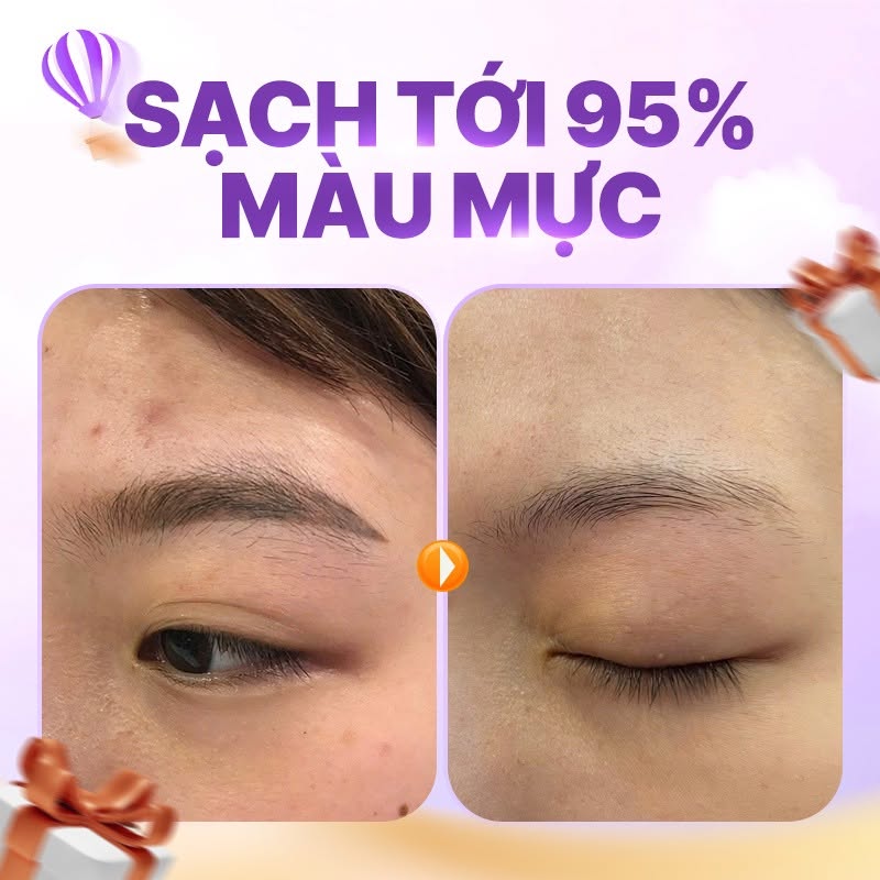 xóa xăm lông mày có bị rụng lông không